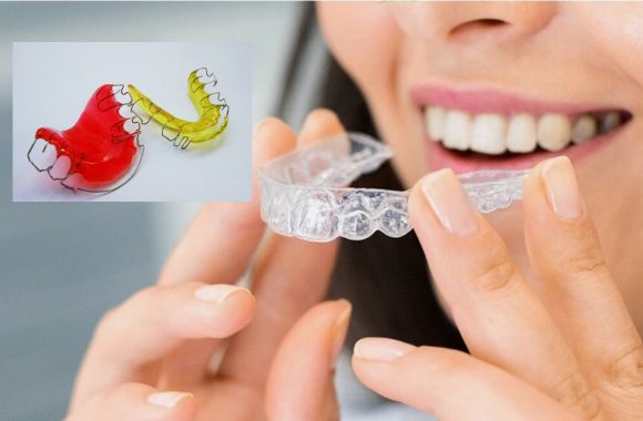 Teeth moving after Invisalign even with retainer